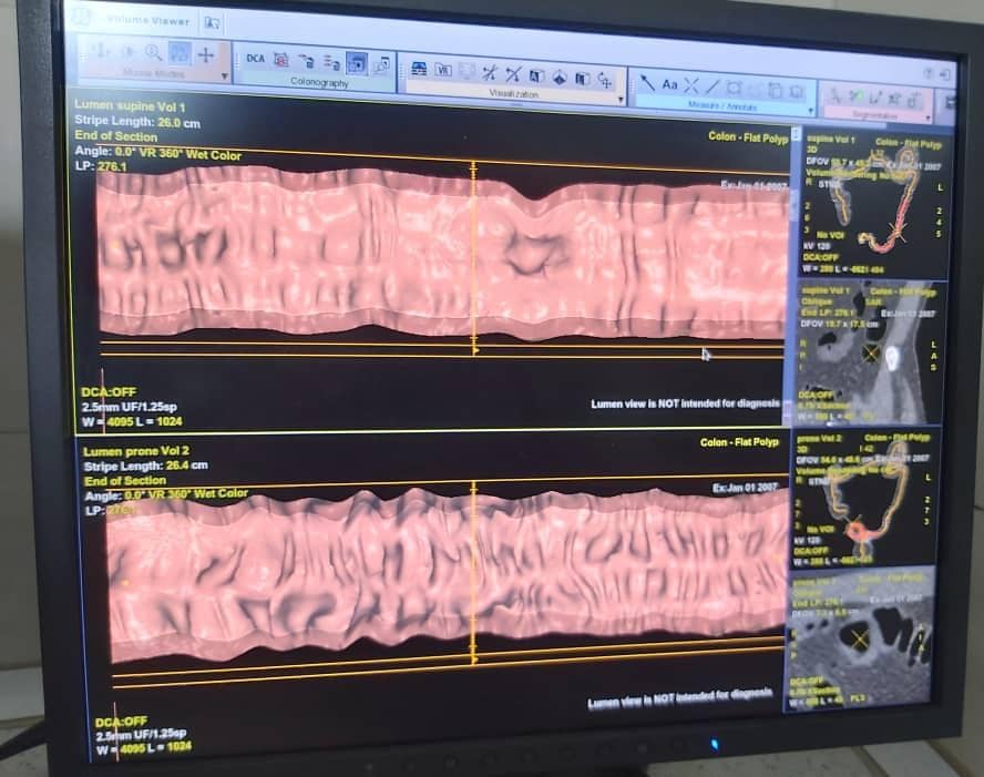 سی تی کولونوسکوپی چیست و خطرات و مزایای آن چیست؟