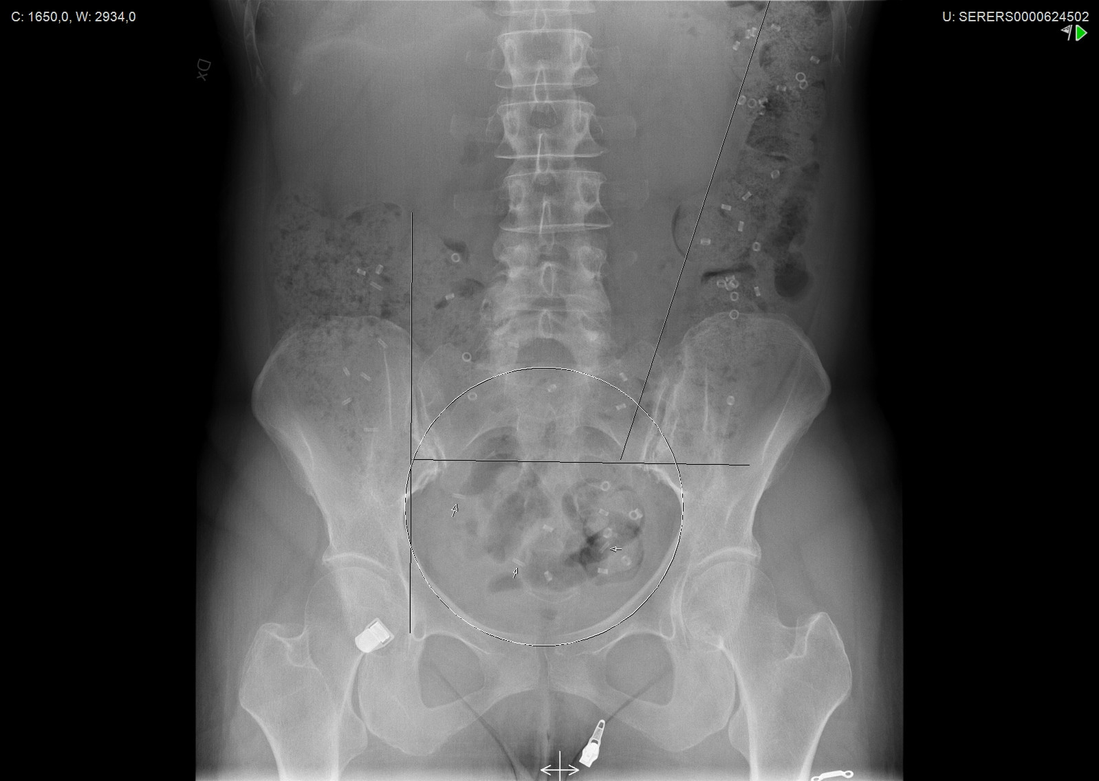 عکس کولون ترانزیت تایم (ctt) چیست؟